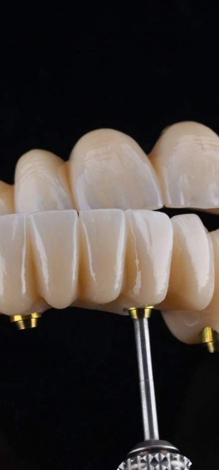 Dental Bridge
